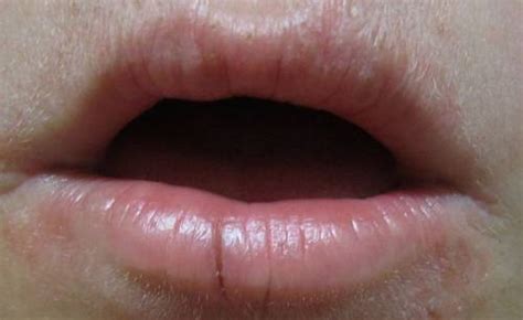 Lips Discoloration Causes And Treatment