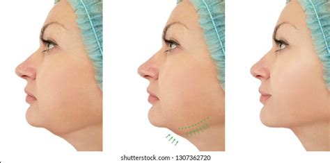 Woman Chin Lift Before After Procedures Stock Photo Edit Now 1307362720
