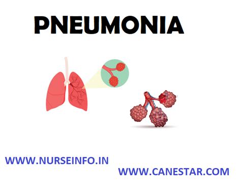 Types Of Pneumonia In Adults