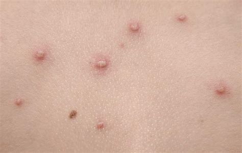 Molluscum Contagiosum Pictures And Symptoms