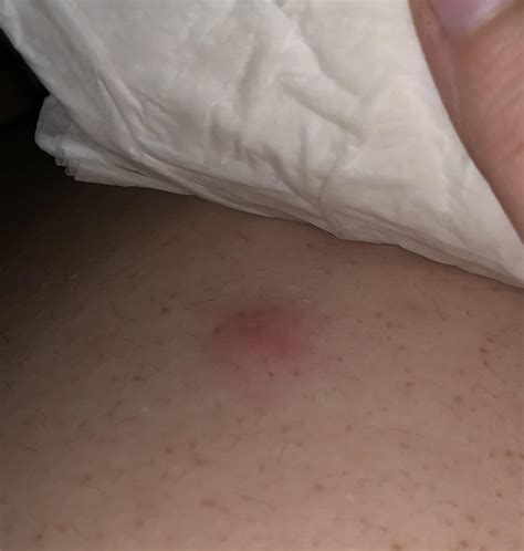 Cyst Or Boil Showed Up Tonight On My Bfs Back About The Size Of A