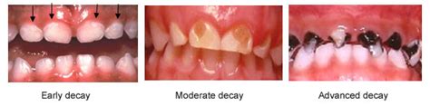 What Are Dental Caries Dental Disease Prevention For Pediatrics