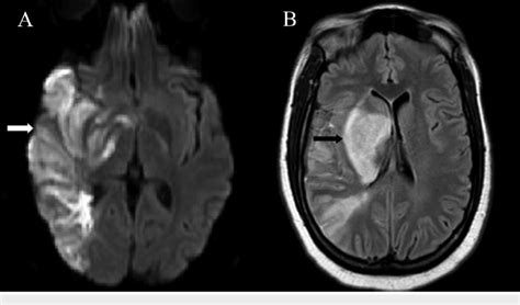 Initial Mri After Ischemic Stroke A Axial Diffusion Weighted Imaging