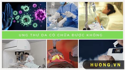 Ung thư da có chữa được không? Cách điều trị bệnh ung thư da - Hương.Vn