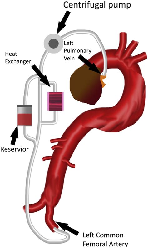 Open Surgery For Descending Thoracic Aorta In An Endovascular Era The