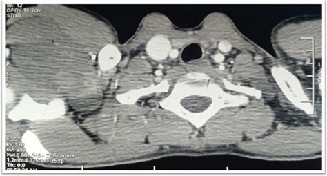 Thoracic Ct Showing A Well Defined Under Right Clavicle Mass Extended