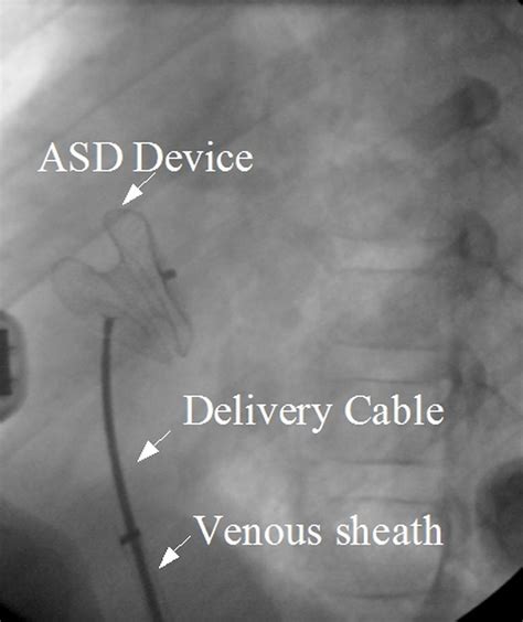 Device Closure Of Atrial Septal Defect Asd All About Cardiovascular