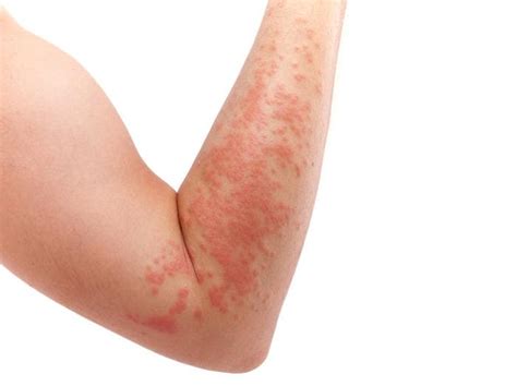 Dermatite Cause Sintomi Rimedi E Cure