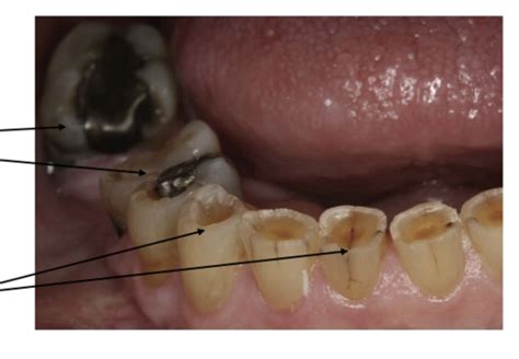 Oral Path Exam 4 Dental Anomalies Part 1 Flashcards Quizlet