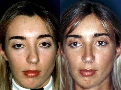 Deviated septum before and after surgery photo