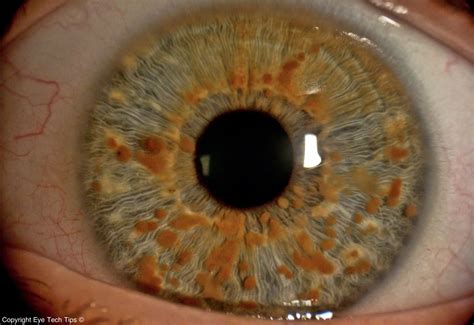 Iris Brushfield Spots Commonly Found In Down Syndrome Patients R