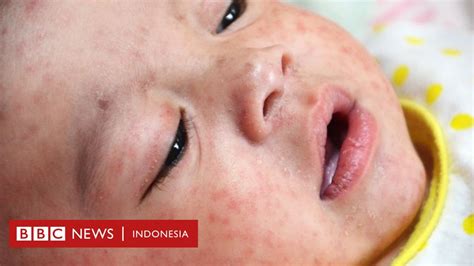 Empat Negara Eropa Tak Lagi Bebas Campak Meski Tingkat Vaksinasi Sangat