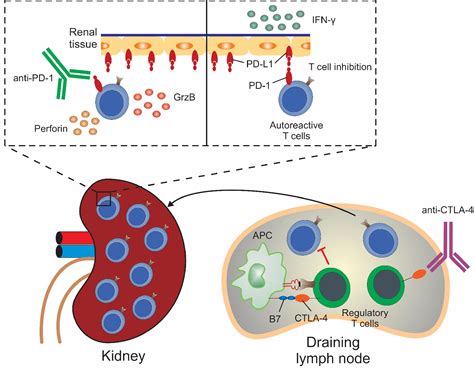 Severe Acute Interstitial Nephritis After Combination Immune Checkpoint