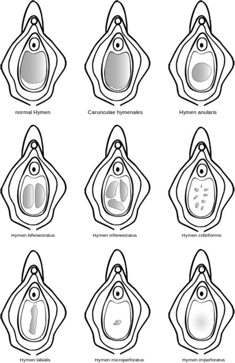 Shows Some Of The Different Configurations Of The Hymen Download Scientific Diagram