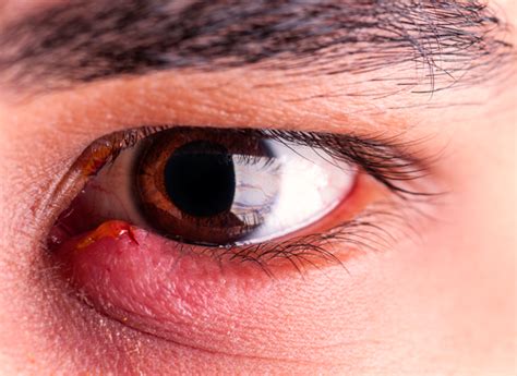 How To Treat And Prevent A Stye In Your Eye Consumer Reports