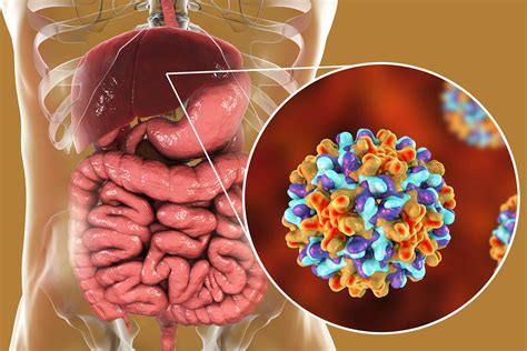 Colorectal Liver Metastasis Linked To Chronic Hepatitis B Infection