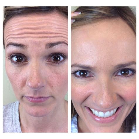 Botox Before And After Photos Forehead Before And After