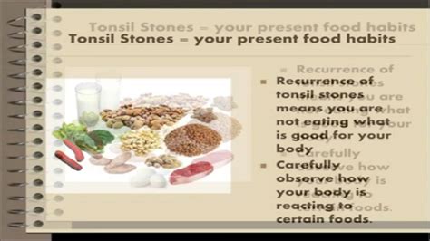 Tonsil Stones Removal Natural Tonsil Stones Home Remedy Youtube