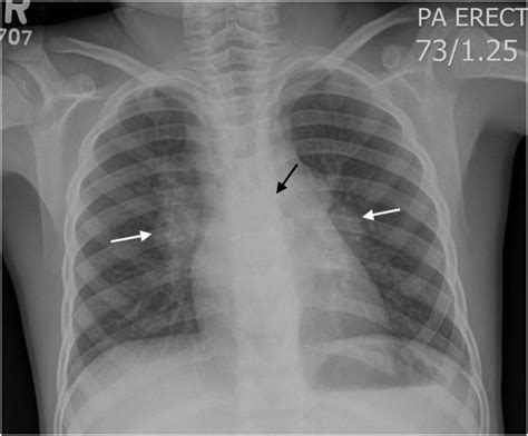 Reliability Of Chest Radiograph Interpretation For Pulmonary
