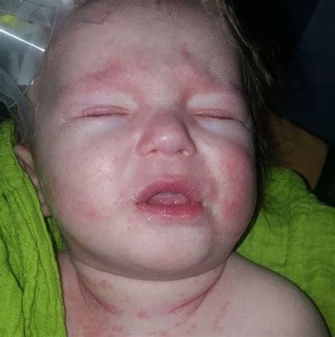 Horrifying Photos Show How Meningitis Rash Grew From A Few Dots To Cover Baby S Whole Body In