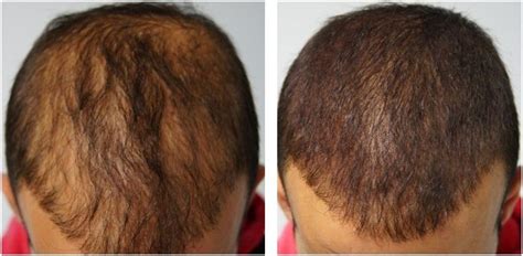 Best Alopecia Areata Treatment In Dubai Hair Transplant Dubai