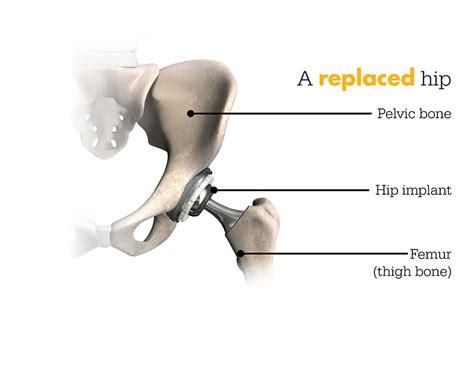Mako Robotic Arm Assisted Total Hip Replacement West Palm Beach