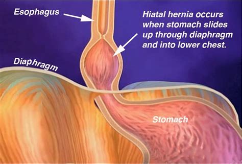 Hiatal Hernias Suncoast Surgical Associates