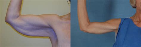 Arm Lift Brachioplasty Before And After Pictures Case 83
