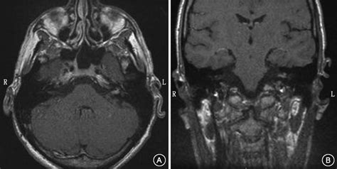 Initial T1 Weighted Gadolinium Mri Showing Prominent Enhancement Within