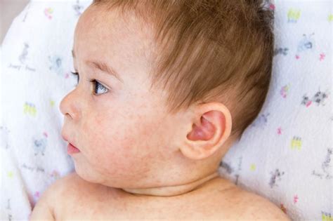 Consejos Para Diagnosticar Y Quitar El Sarpullido Por Calor En Bebés