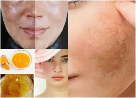 5 Do It Yourself Cures For Melasma And Darkish Spots