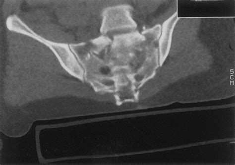 Current Management Of U Shaped Sacral Fractures Or Spino Pelvic