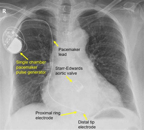 Medtronic Pacemaker X Ray Identification