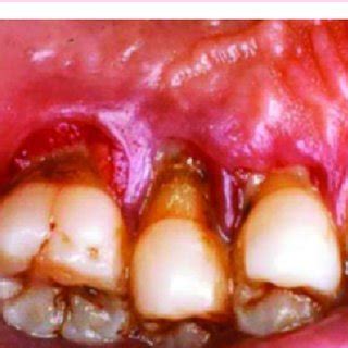 Oral Candidiasis In A Patient With Poorly Controlled Diabetes Mellitus