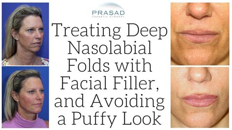 How To Get Rid Of Nasolabial Folds Without Fillers Smile So That The