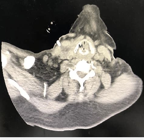 Ct Of The Neck Showing A Well Defined Hypodense Submucosal Lesion M