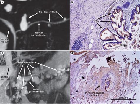 Comparison Of Side Branch Ipmn And Main Duct Ipmc By Mri And