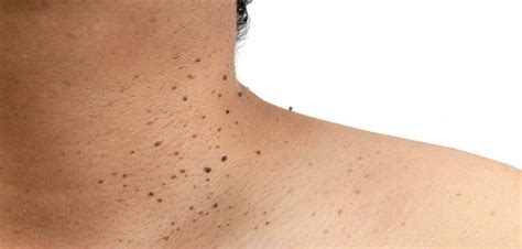 Skin Tag Removal Bradford Verruca And Wart Removal Myskyn Clinic