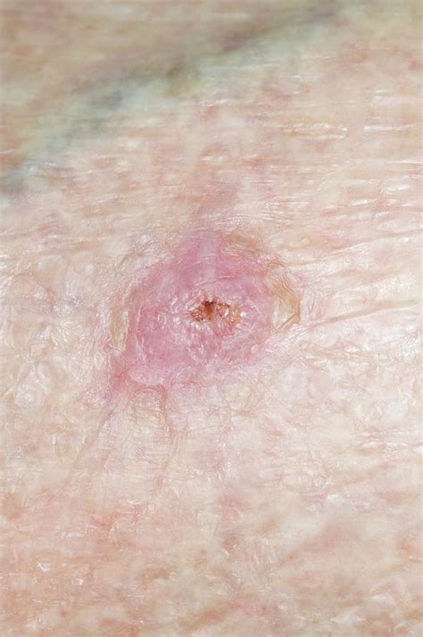 Basal Cell Carcinoma Skin Cancer Photograph By Dr P Marazziscience