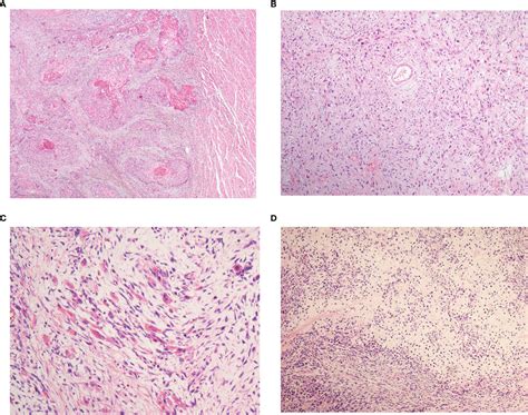 Frontiers Clinicopathological And Prognostic Characteristics Of Esophageal Spindle Cell
