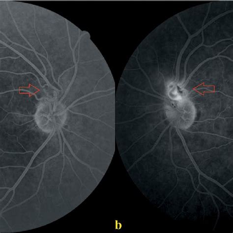 Fundus Fluorescein Angiography Imaging Of The Right A And Left Eyes