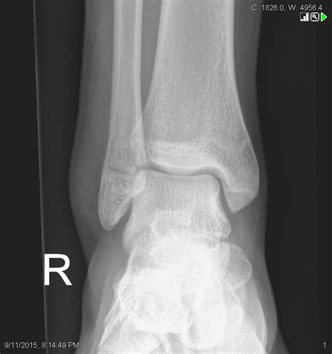 Ankle Fractures Trauma