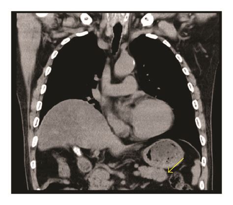 Abdominal Computed Tomography Imaging Demonstrating A 27 Mm Mass In The
