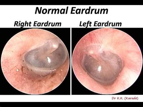 How do you know if your eardrum is ruptured. Oto-endoscopy : How Normal Ear Drum ( Tympanic Membrane ...