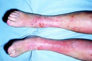 Importance Of Distinguishing Between Cellulitis And Varicose Eczema Of