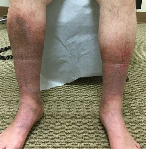 Light Brown Spots Appearing On Legs