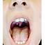 I Finally Looked This Up Apparently Have A Bifid Uvula Only Seen In 