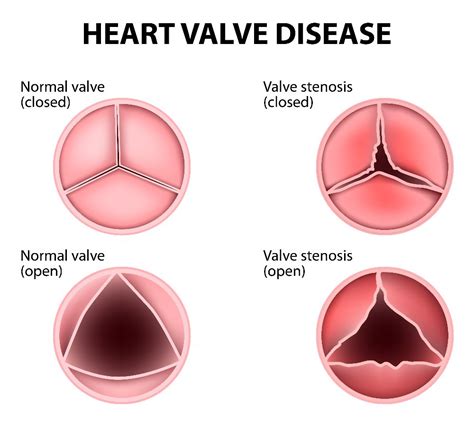 Frequently Asked Questions About Heart Valve Disease Facty Health