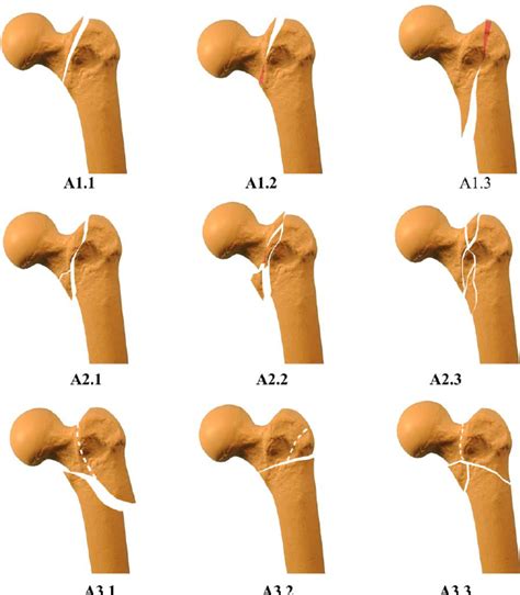 The AO OTA Classification Of The Extracapsular Proximal Femur Fractures