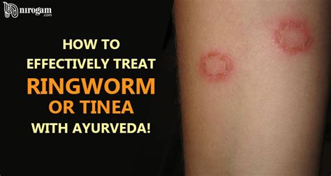 How To Effectively Treat Ringworm Or Tinea With Ayurveda Nirogam